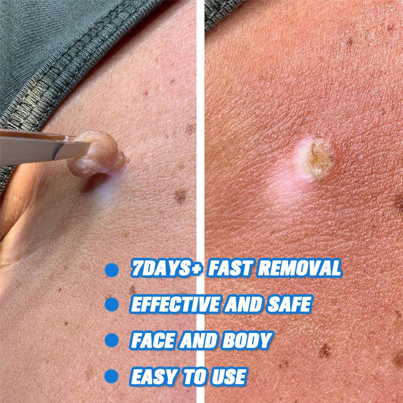 iBeaLee 20ml Skin Tag Remover Fast Effective Safe