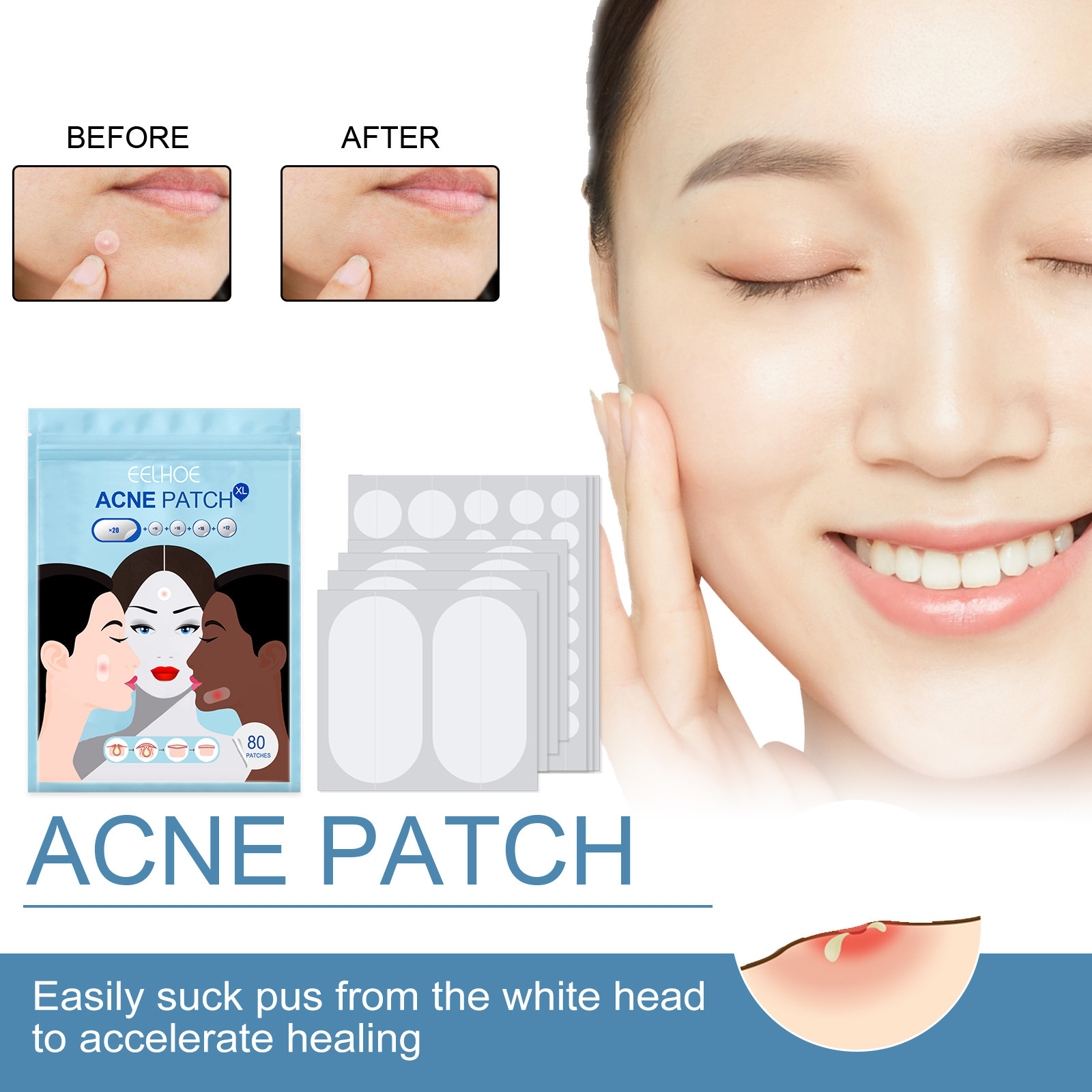 80Pcs Large Size Acne Patches Removal Pimple Anti Acne Hydrocolloid Bandage Patches Spots Marks Concealer Repair Sticker Skin Blemish Remover Skin Care