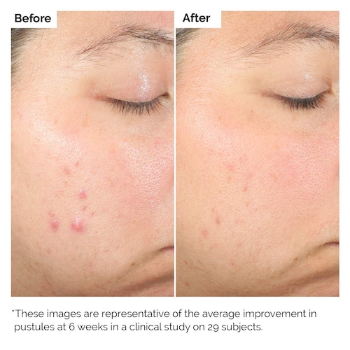 The Ordinary Salicylic Acid 2 Percent Exfoliating Blemish Solution 30ml