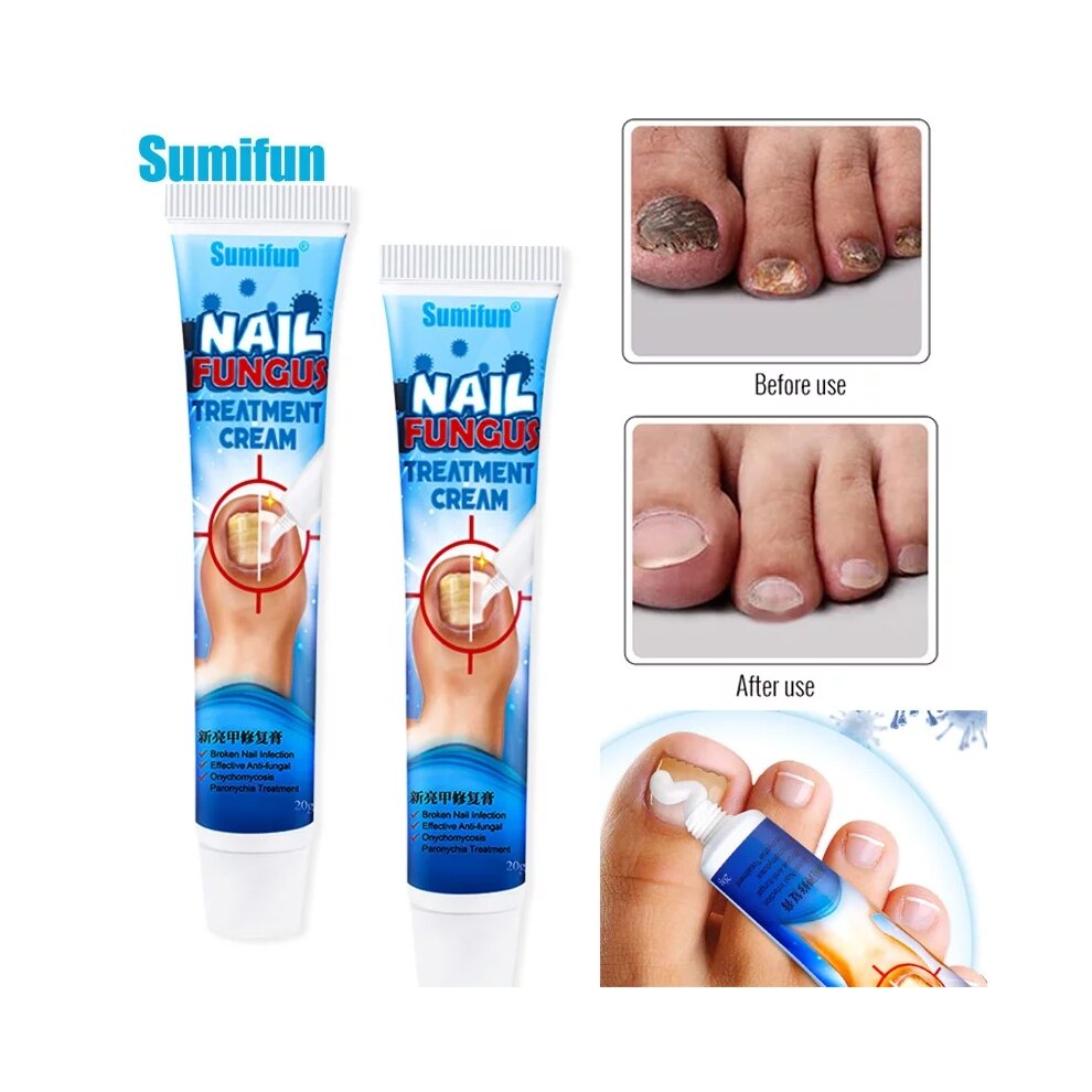 Herbal Toe Nail Fungus Treatment Cream Onychomycosis Paronychia Antibacterial Anti Fungal Infection Repair Ointment