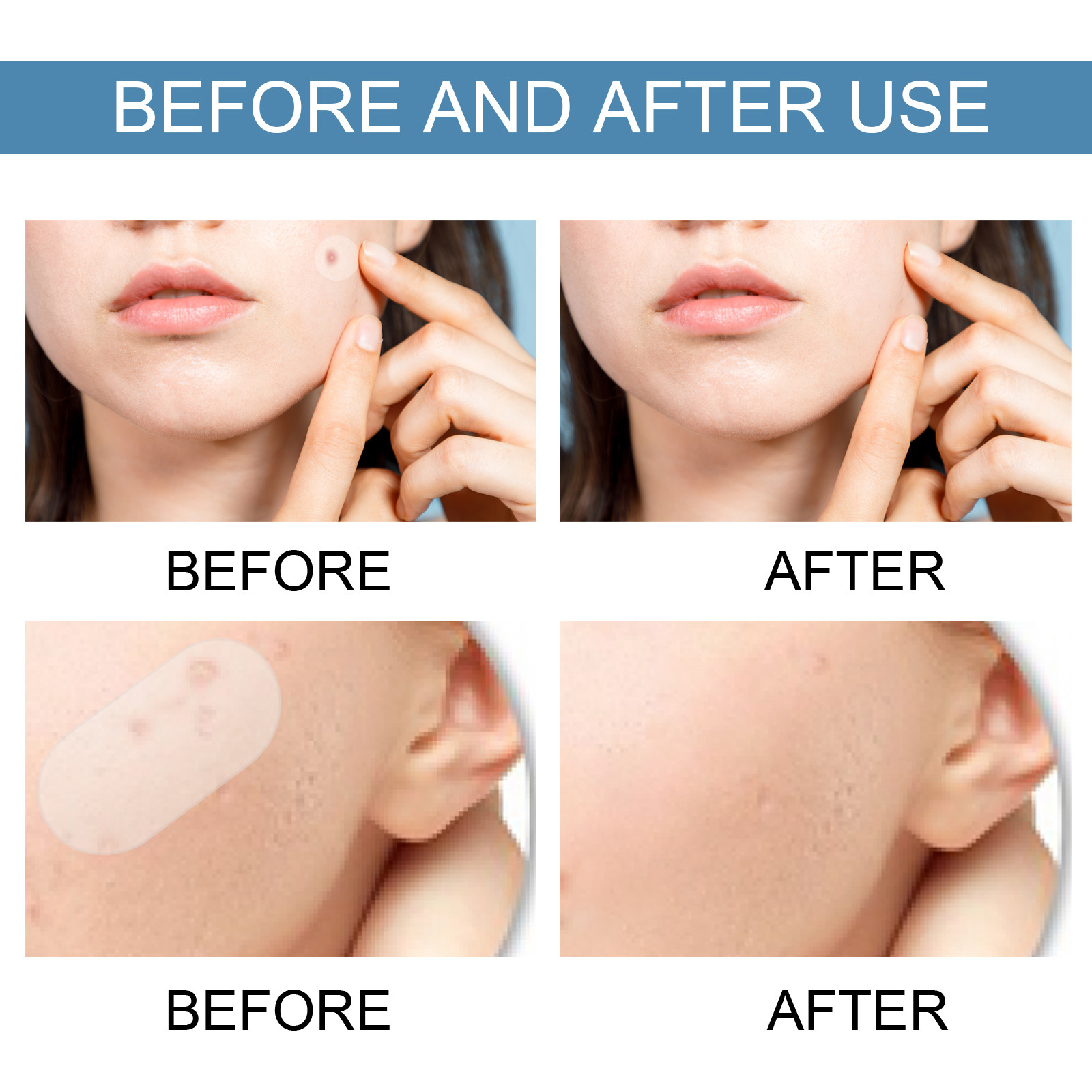 80Pcs Large Size Acne Patches Removal Pimple Anti Acne Hydrocolloid Bandage Patches Spots Marks Concealer Repair Sticker Skin Blemish Remover Skin Care