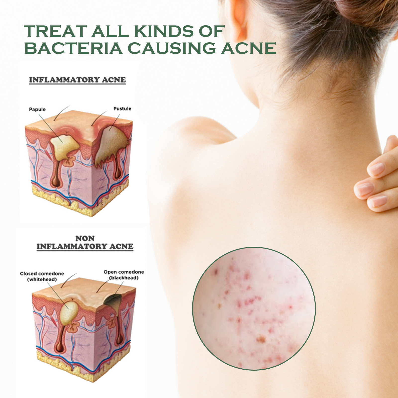 (1 PC) Body Acne Removal Cleanser Spray for Back and Arm Anti-acne Water Oil Balance Remove Redness Shrinking Pores Clean Body Pimple Remover Spray