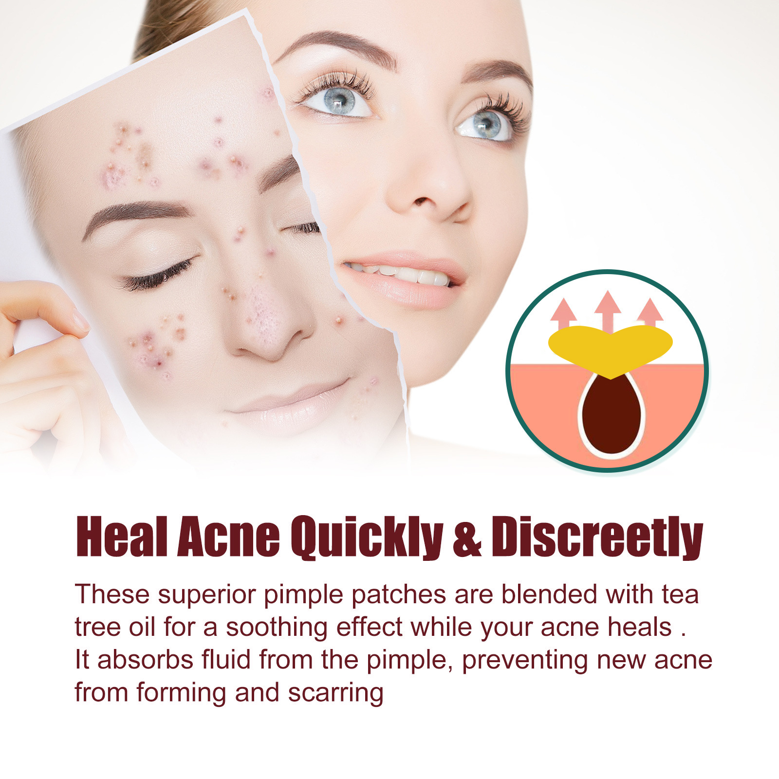 Heart Shaped Acne Patch Hydrocolloid Tea Tree Oil Witch Hazel For Blemish Cover And Daily Skincare