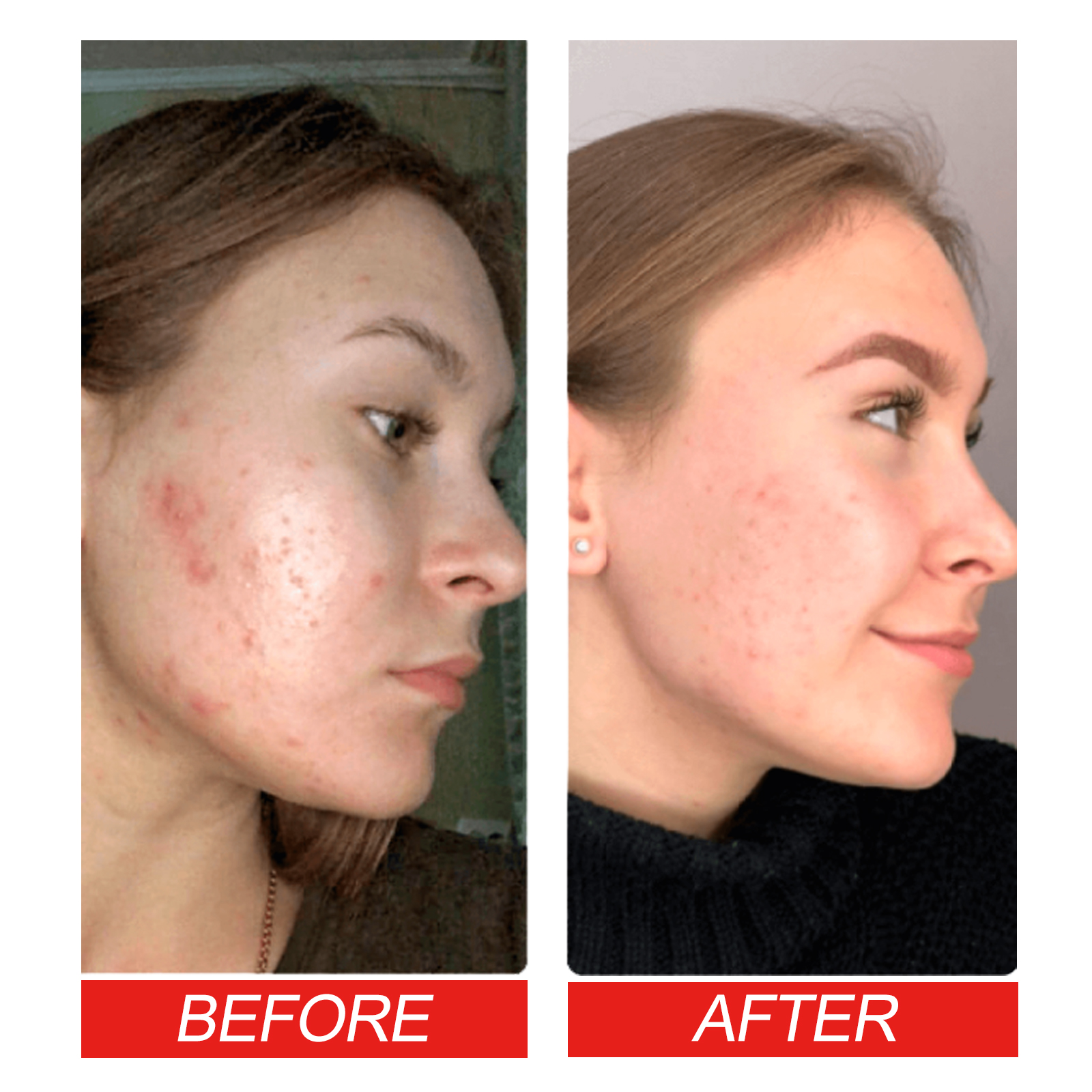 Heart Shaped Acne Patch Hydrocolloid Tea Tree Oil Witch Hazel For Blemish Cover And Daily Skincare