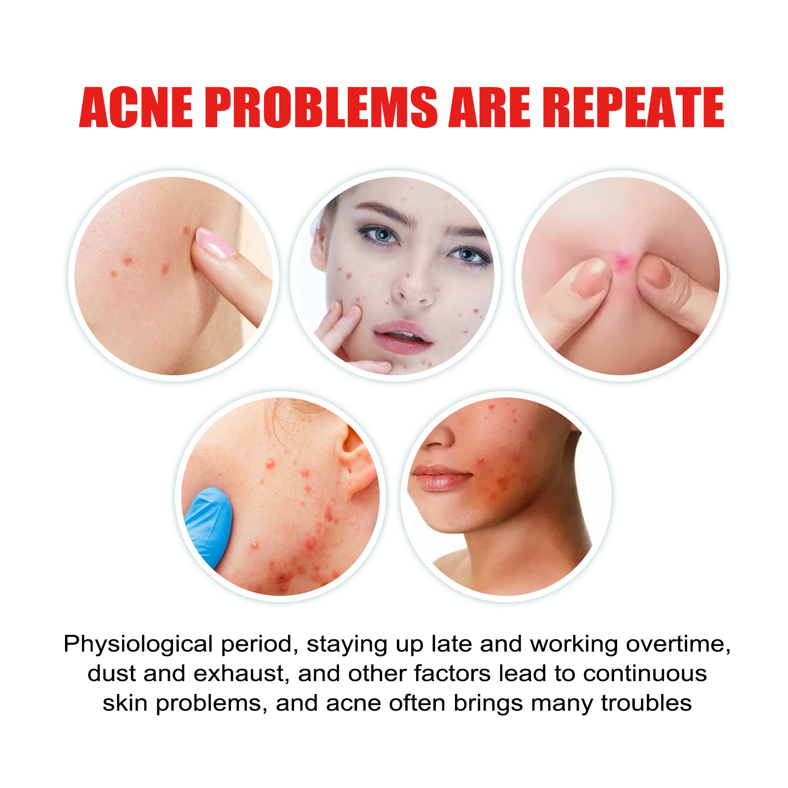 Heart Shaped Acne Patch Hydrocolloid Tea Tree Oil Witch Hazel For Blemish Cover And Daily Skincare