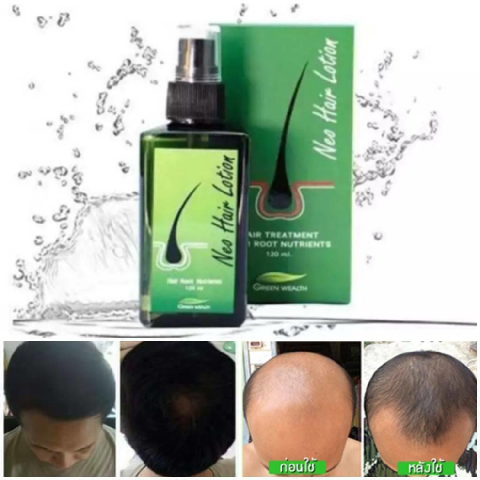 Neo Hair Lotion Extra Strength Regrowth Serum Hair Treatment 120 Ml