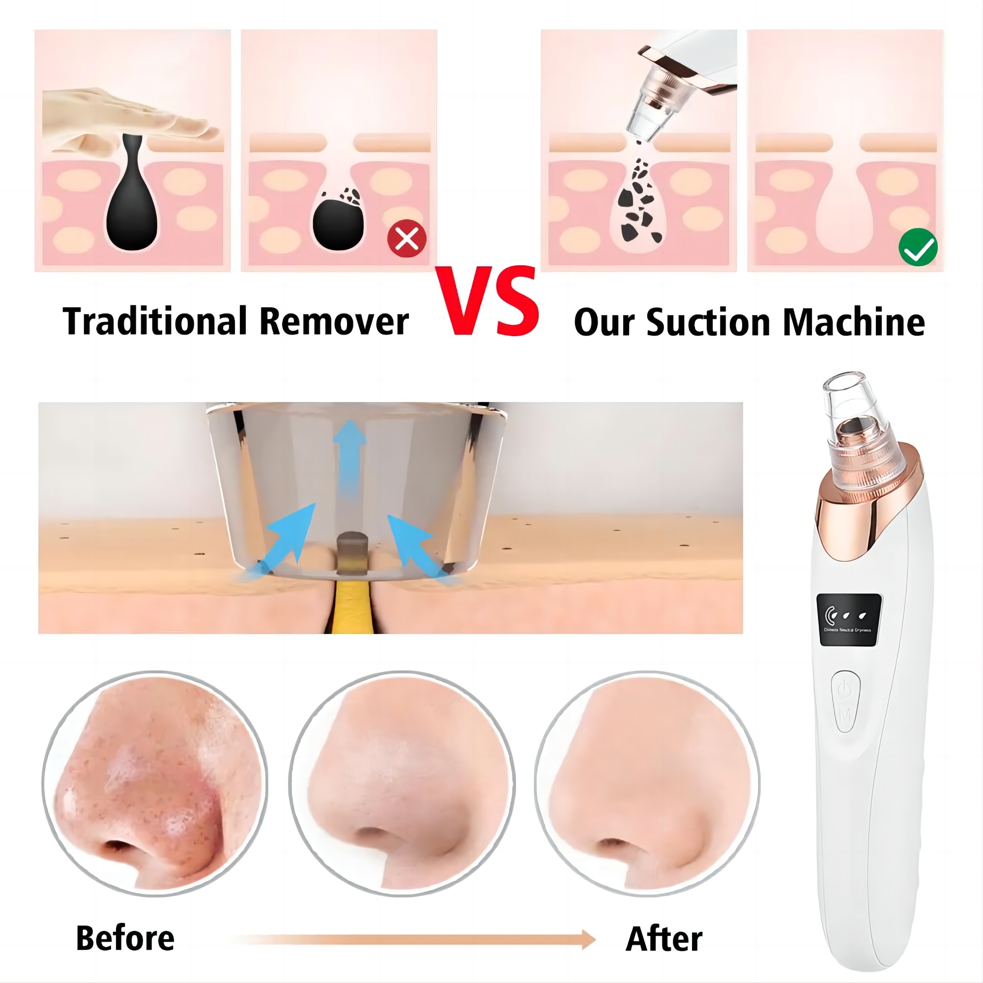 Blackhead Remover Vacuum Pore Cleaner for Face Nose Mite Blackhead Removal Instrument Kit Electric Acne Facial Extractor Tool Newest Technology