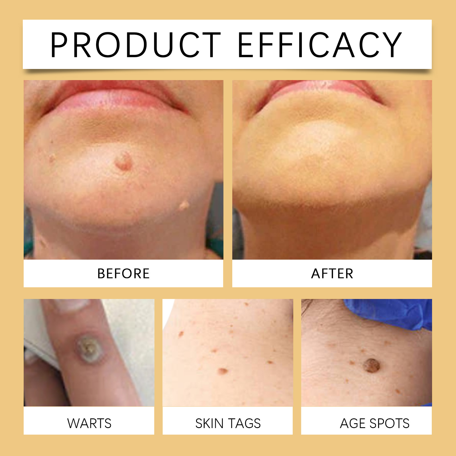 Bee Venom Wart And Mole Skin Care Cream Herbal Mild Fade Skin Mole Clean Skin Care Ointment