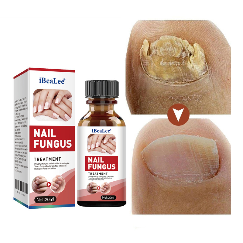iBeaLee Nail Fungus Treatment Onychomycosis Repair Liquid Anti-Infective Oil Essence Serum Hand And Foot Care Supplies for Men Women 20ml