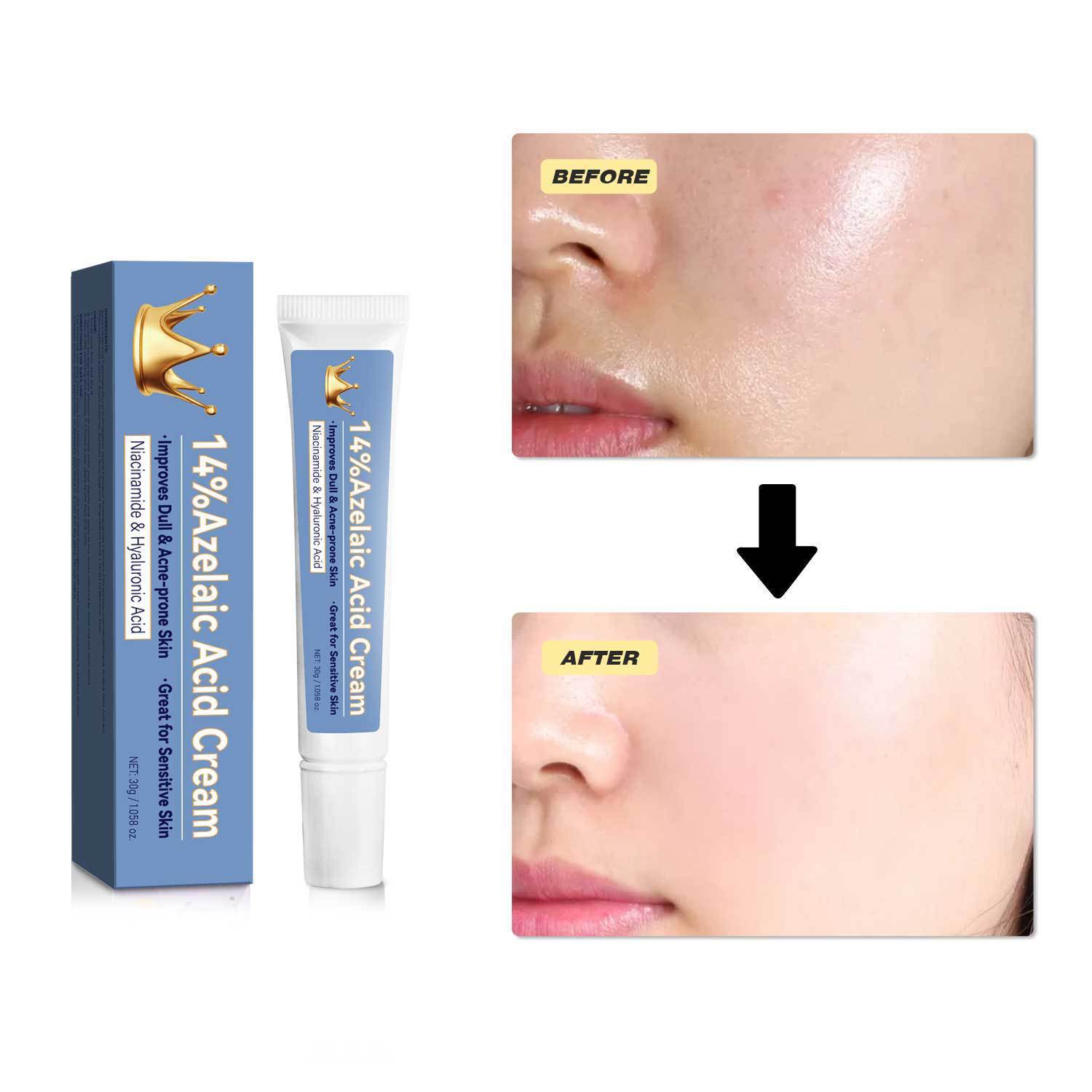 Azelaic Acid Cream Blemish Care Soothing Moisturizer For Acne Prone Skin Redness Relief And Pore Refining Daily Face Treatment 30g
