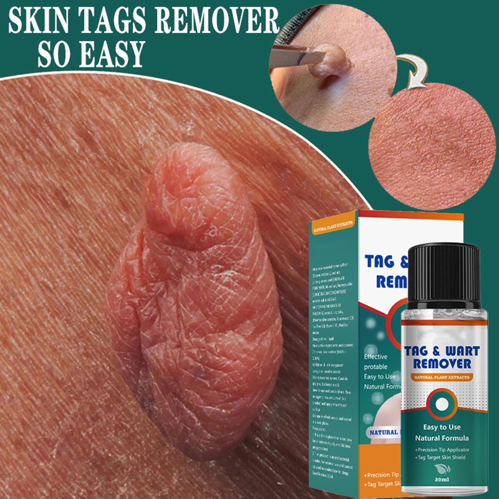 (1 pc) Skin Tag Remover Cream Painless Mole Skin Dark Spot Warts Remover Natural Skin Tag Mole Removal for Face and Body