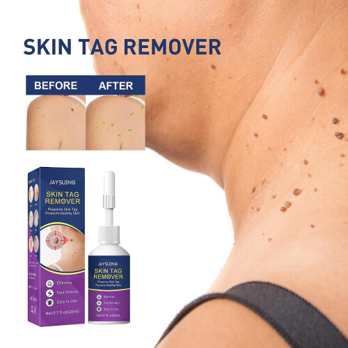 Skin Tag Remover   Skin Tag Remover Serum  From
