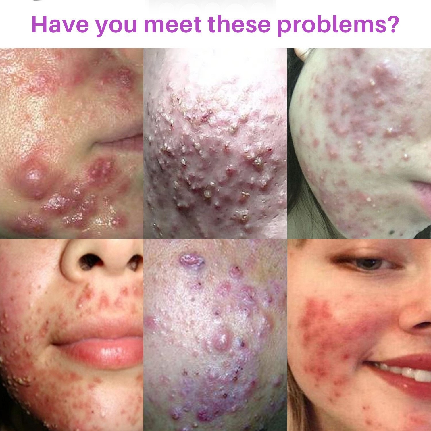 Invisible Acne Patch Hydrocolloid Blemish Spot Cover for Pimples Blackheads Zit Removal Daily Skin Care Natural
