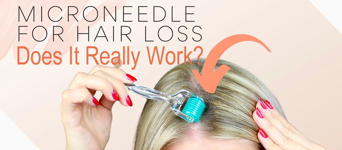 Microneedling for Hair Loss Treatment: Does It Really Work?